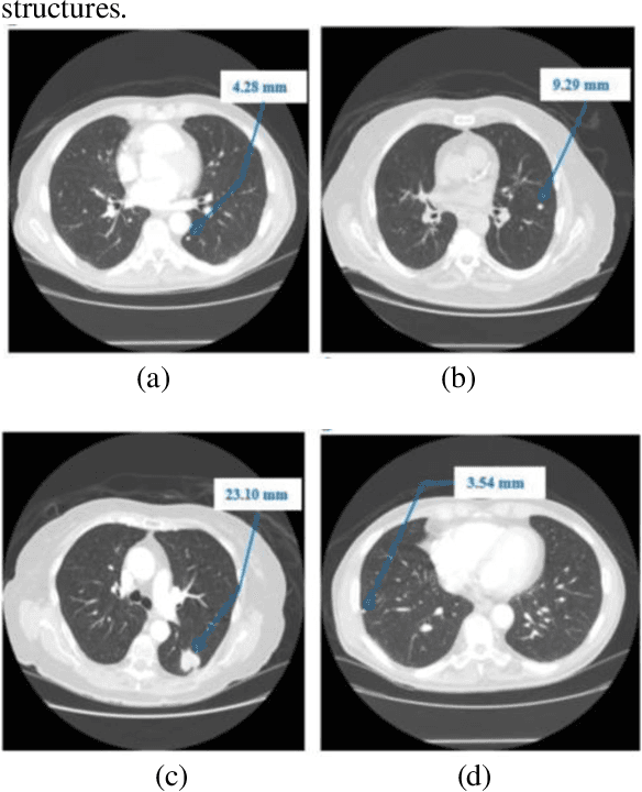 Figure 1 for Early Diagnosis of Lung Cancer Using Computer Aided Detection via Lung Segmentation Approach