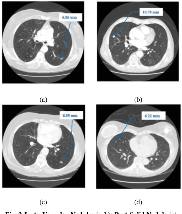 Figure 2 for Early Diagnosis of Lung Cancer Using Computer Aided Detection via Lung Segmentation Approach