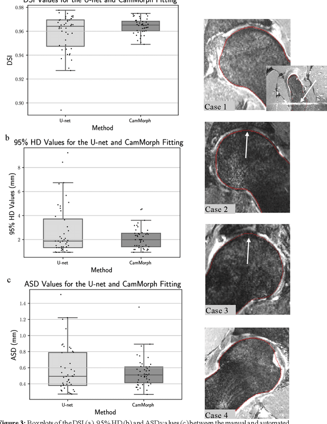 Figure 4 for Automated volumetric and statistical shape assessment of cam-type morphology of the femoral head-neck region from 3D magnetic resonance images