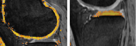 Figure 3 for Automated Segmentation of Knee MRI Using Hierarchical Classifiers and Just Enough Interaction Based Learning: Data from Osteoarthritis Initiative
