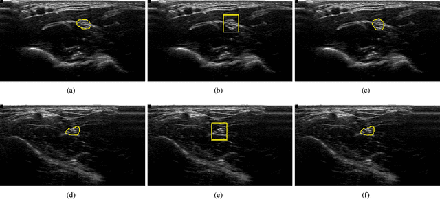 Figure 3 for Deep learning with spatiotemporal consistency for nerve segmentation in ultrasound images