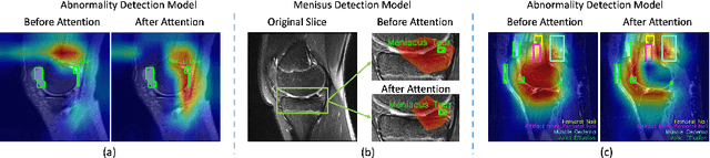Figure 1 for Optimising Knee Injury Detection with Spatial Attention and Validating Localisation Ability