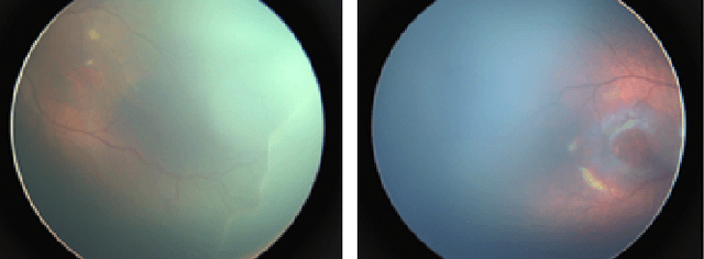 Figure 1 for Transfer Learning for Retinal Vascular Disease Detection: A Pilot Study with Diabetic Retinopathy and Retinopathy of Prematurity