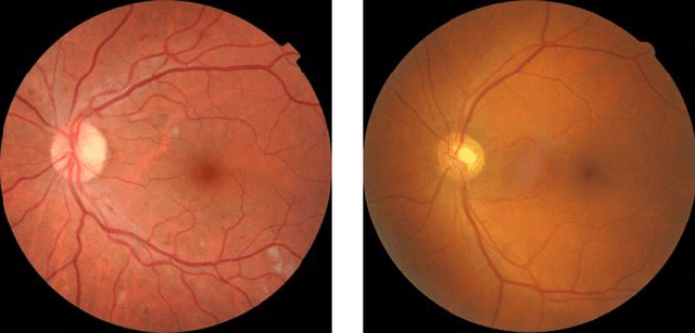 Figure 3 for Transfer Learning for Retinal Vascular Disease Detection: A Pilot Study with Diabetic Retinopathy and Retinopathy of Prematurity