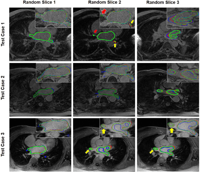 Figure 4 for Dilated Convolutions in Neural Networks for Left Atrial Segmentation in 3D Gadolinium Enhanced-MRI