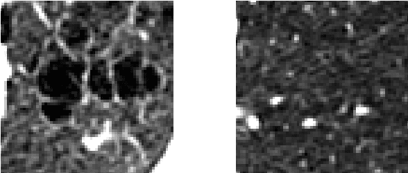 Figure 1 for Classification of COPD with Multiple Instance Learning