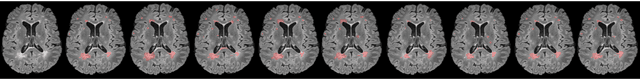 Figure 3 for Multiple Sclerosis Lesions Identification/Segmentation in Magnetic Resonance Imaging using Ensemble CNN and Uncertainty Classification