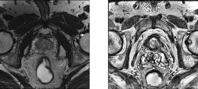 Figure 1 for Improving prostate whole gland segmentation in t2-weighted MRI with synthetically generated data