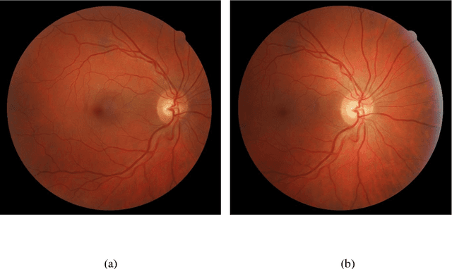 Figure 1 for Deep Learning for Automated Quality Assessment of Color Fundus Images in Diabetic Retinopathy Screening