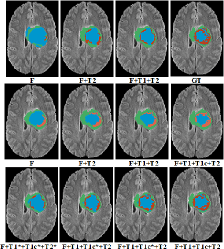 Figure 4 for Modality Completion via Gaussian Process Prior Variational Autoencoders for Multi-Modal Glioma Segmentation