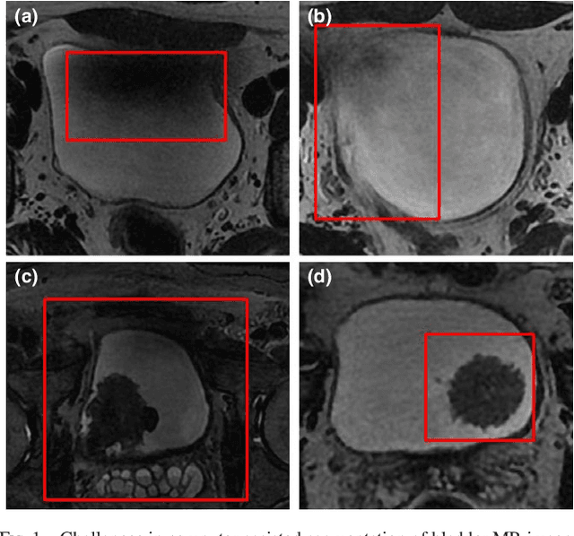 Figure 1 for Multi-region segmentation of bladder cancer structures in MRI with progressive dilated convolutional networks
