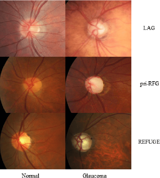 Figure 2 for Self-Adaptive Transfer Learning for Multicenter Glaucoma Classification in Fundus Retina Images
