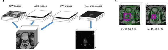 Figure 1 for Implementation of Convolutional Neural Network Architecture on 3D Multiparametric Magnetic Resonance Imaging for Prostate Cancer Diagnosis