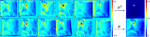 Figure 2 for Uncertainty Estimation in Medical Image Localization: Towards Robust Anterior Thalamus Targeting for Deep Brain Stimulation