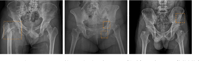 Figure 1 for Weakly Supervised Universal Fracture Detection in Pelvic X-rays