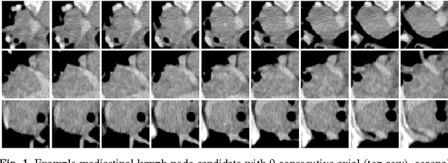 Figure 1 for 2D View Aggregation for Lymph Node Detection Using a Shallow Hierarchy of Linear Classifiers