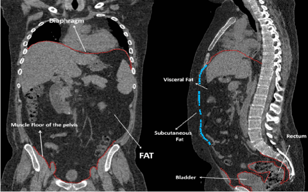 Figure 1 for Context Driven Label Fusion for segmentation of Subcutaneous and Visceral Fat in CT Volumes