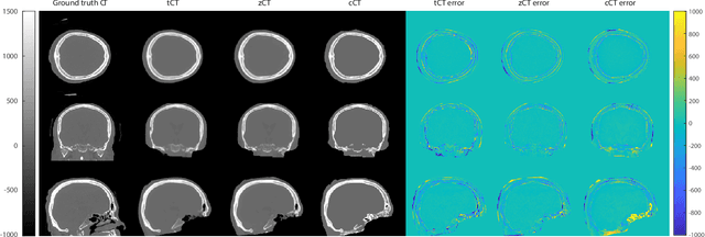 Figure 3 for Classical and learned MR to pseudo-CT mappings for accurate transcranial ultrasound simulation