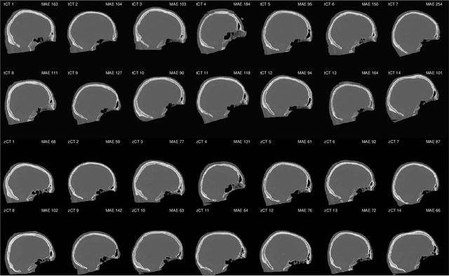 Figure 4 for Classical and learned MR to pseudo-CT mappings for accurate transcranial ultrasound simulation