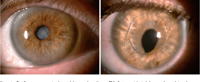 Figure 1 for Iris recognition in cases of eye pathology