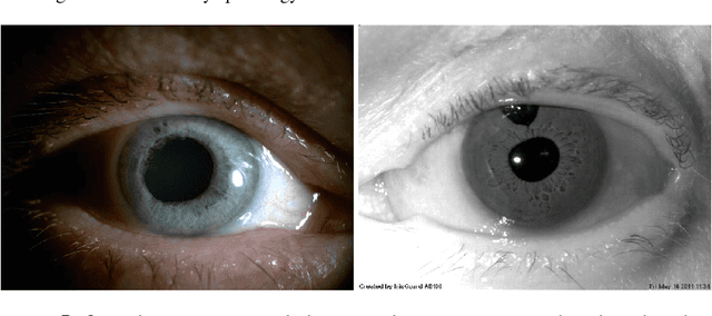 Figure 3 for Iris recognition in cases of eye pathology