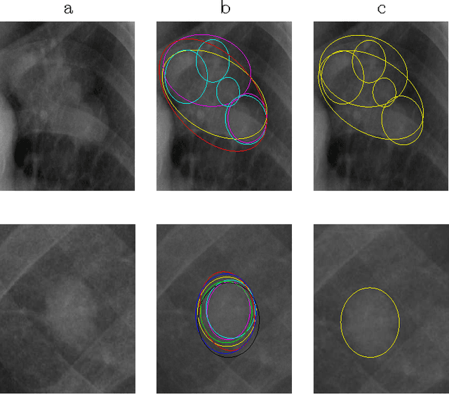 Figure 1 for Cancer Detection with Multiple Radiologists via Soft Multiple Instance Logistic Regression and $L_1$ Regularization