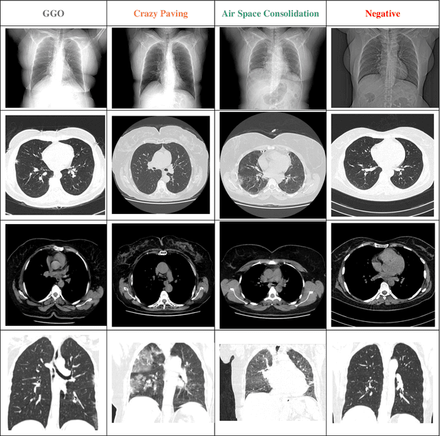 Figure 2 for A High-Resolution Chest CT-Scan Image Dataset for COVID-19 Diagnosis and Differentiation