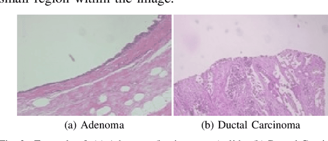 Figure 3 for Double Transfer Learning for Breast Cancer Histopathologic Image Classification