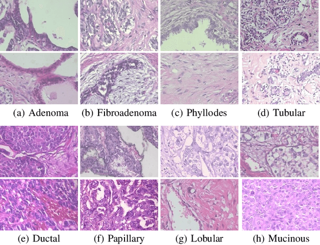 Figure 4 for Double Transfer Learning for Breast Cancer Histopathologic Image Classification