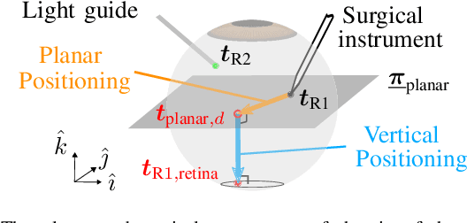 Figure 4 for Autonomous Coordinated Control of the Light Guide for Positioning in Vitreoretinal Surgery