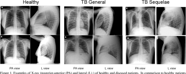 Figure 1 for Improving Tuberculosis (TB) Prediction using Synthetically Generated Computed Tomography (CT) Images