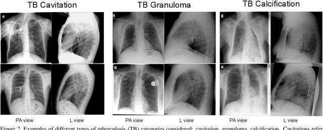 Figure 3 for Improving Tuberculosis (TB) Prediction using Synthetically Generated Computed Tomography (CT) Images