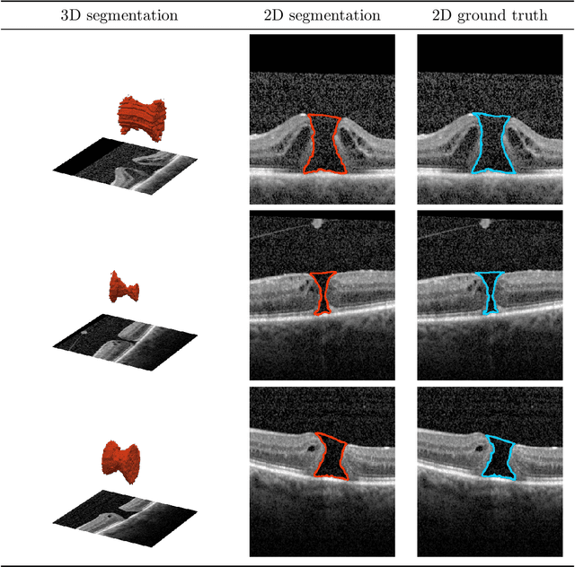 Figure 2 for Robust 3D U-Net Segmentation of Macular Holes