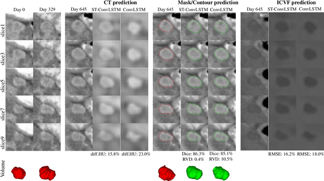 Figure 4 for Spatial-Temporal Convolutional LSTMs for Tumor Growth Prediction by Learning 4D Longitudinal Patient Data