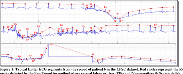 Figure 1 for Robust R-Peak Detection in Low-Quality Holter ECGs using 1D Convolutional Neural Network