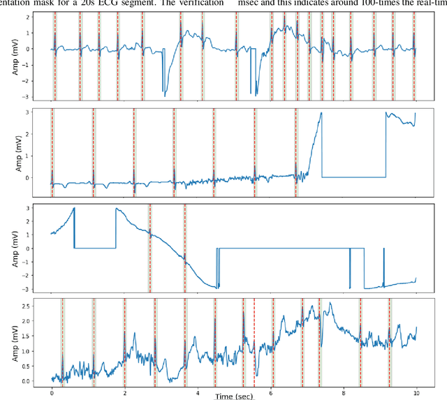 Figure 4 for Robust R-Peak Detection in Low-Quality Holter ECGs using 1D Convolutional Neural Network