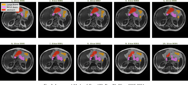 Figure 3 for Medical Image Segmentation using LeViT-UNet++: A Case Study on GI Tract Data