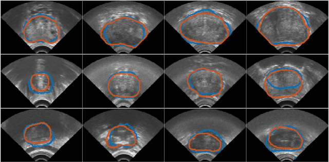 Figure 3 for Automatic Segmentation of the Prostate on 3D Trans-rectal Ultrasound Images using Statistical Shape Models and Convolutional Neural Networks