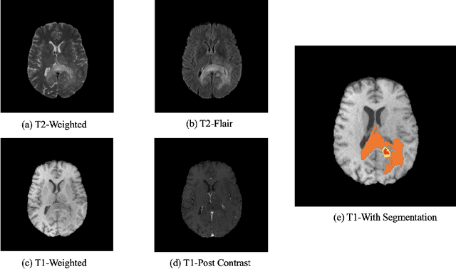 Figure 1 for A Two-Stage Cascade Model with Variational Autoencoders and Attention Gates for MRI Brain Tumor Segmentation