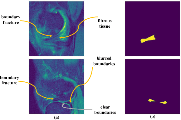 Figure 3 for Automatic segmentation of meniscus based on MAE self-supervision and point-line weak supervision paradigm