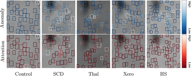 Figure 4 for Anomaly-aware multiple instance learning for rare anemia disorder classification