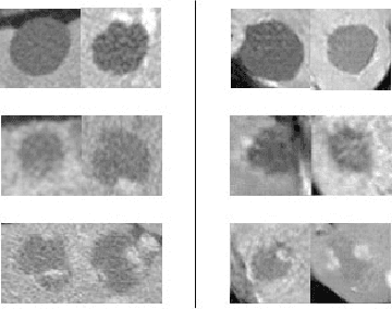 Figure 1 for Synthetic Data Augmentation using GAN for Improved Liver Lesion Classification