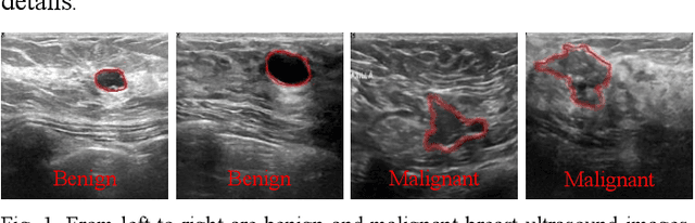 Figure 1 for BAGNet: Bidirectional Aware Guidance Network for Malignant Breast lesions Segmentation