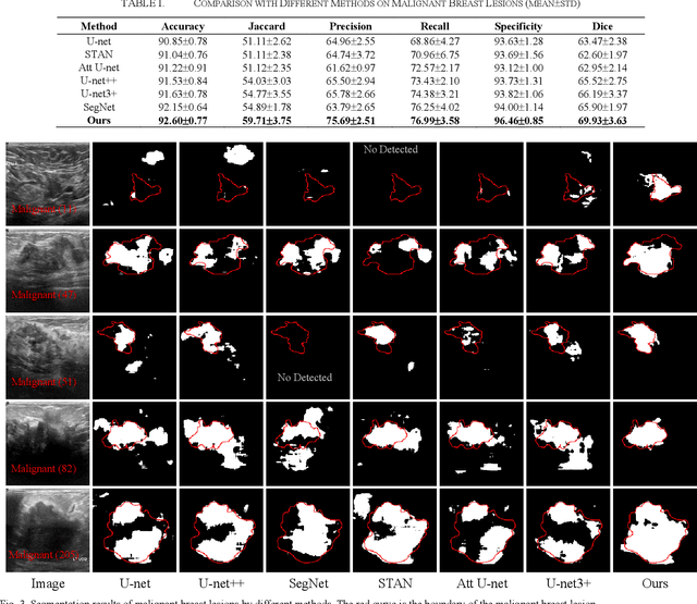 Figure 3 for BAGNet: Bidirectional Aware Guidance Network for Malignant Breast lesions Segmentation