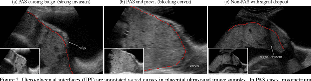 Figure 3 for UPI-Net: Semantic Contour Detection in Placental Ultrasound