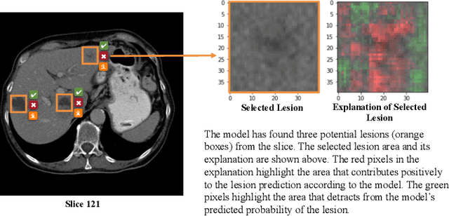 Figure 2 for An AI-Augmented Lesion Detection Framework For Liver Metastases With Model Interpretability