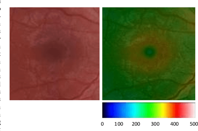 Figure 1 for Heightmap Reconstruction of Macula on Color Fundus Images Using Conditional Generative Adversarial Networks