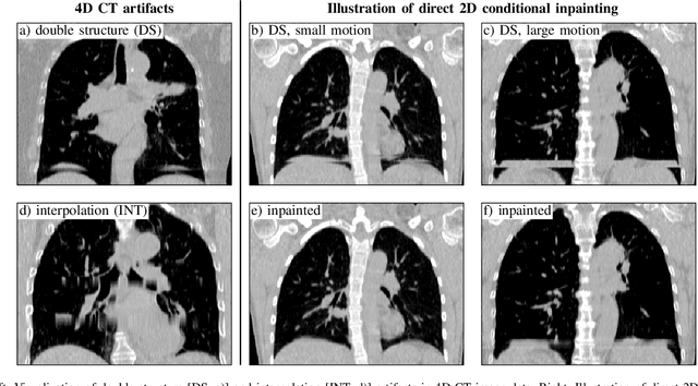 Figure 1 for Deep learning-based conditional inpainting for restoration of artifact-affected 4D CT images