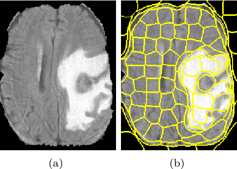 Figure 1 for Fast Glioblastoma Detection in Fluid-attenuated inversion recovery (FLAIR) images by Topological Explainable Automatic Machine Learning