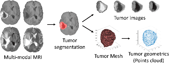 Figure 1 for Collaborative learning of images and geometrics for predicting isocitrate dehydrogenase status of glioma